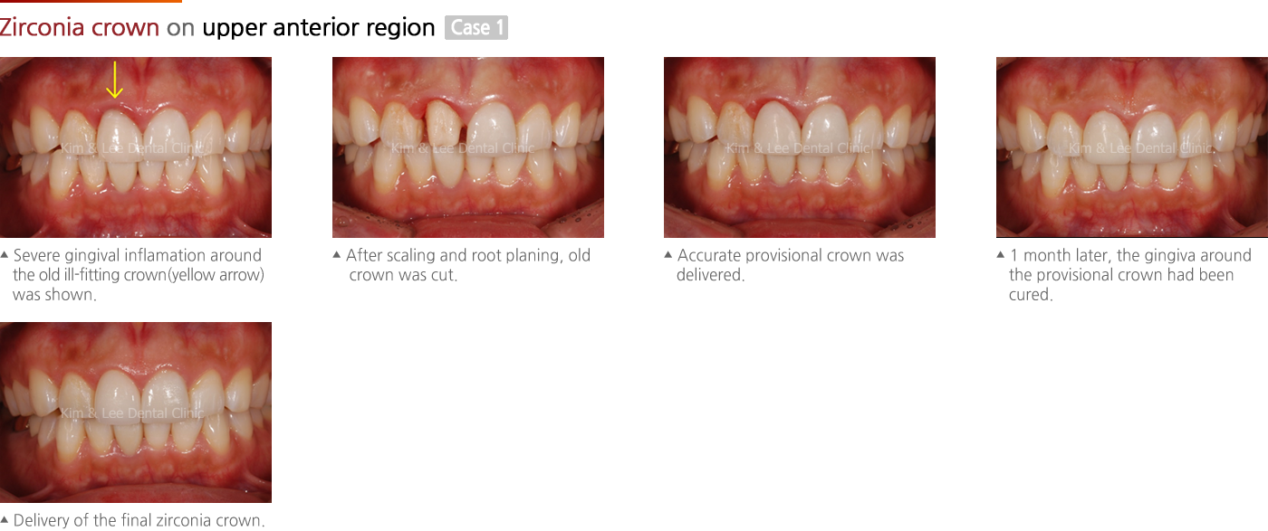 Zirconia crown on upper anterior region