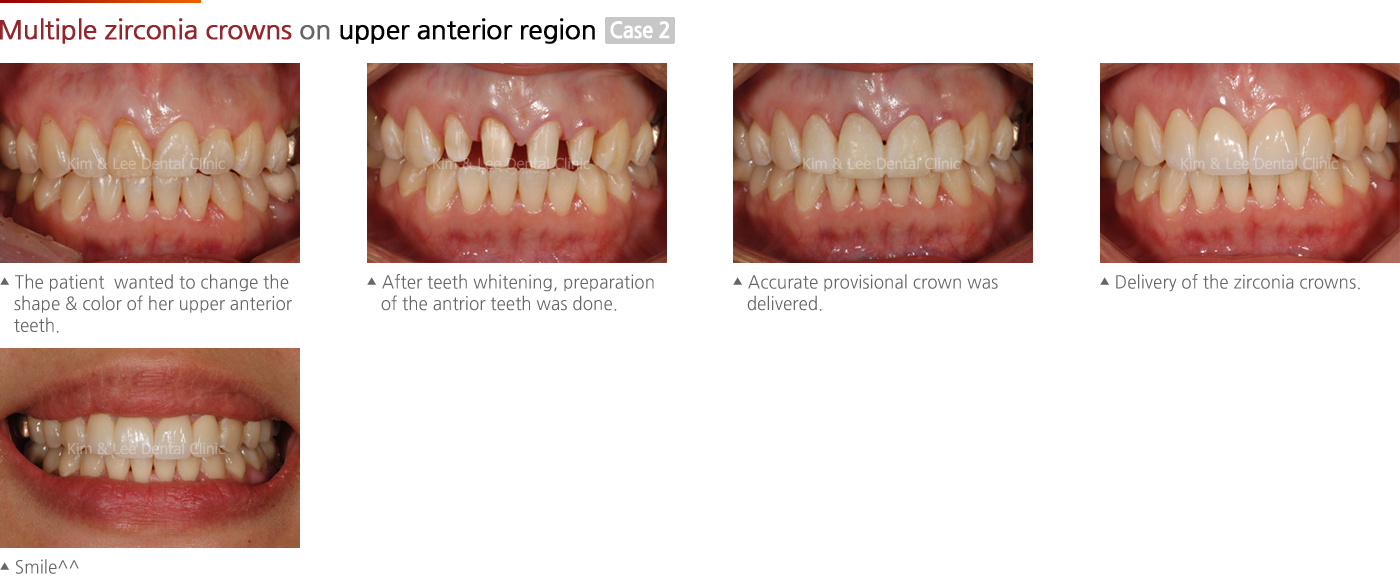 Multiple zirconia crowns on upper anterior region