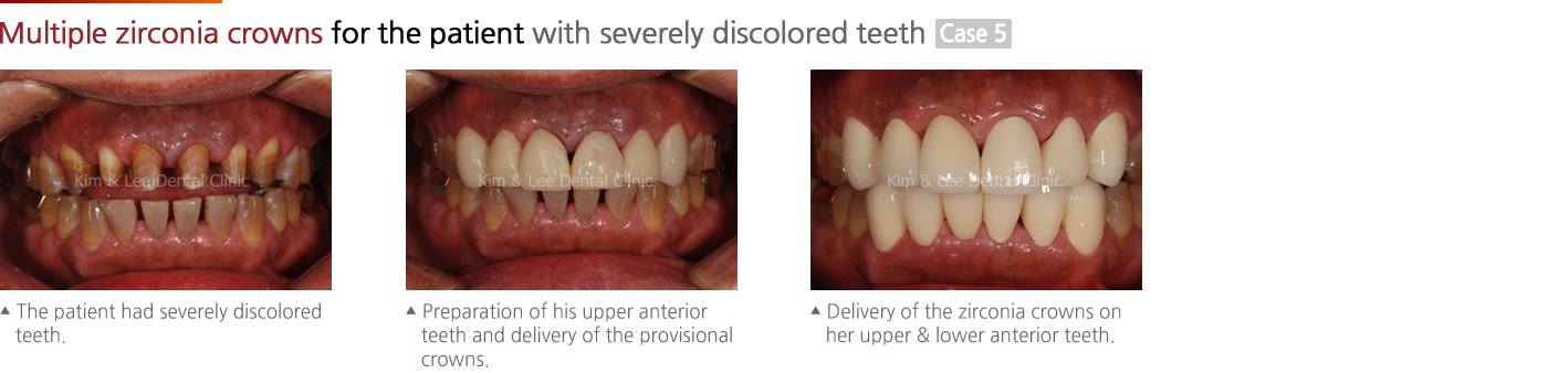 Multiple zirconia crowns for the patient with severely discolored teeth