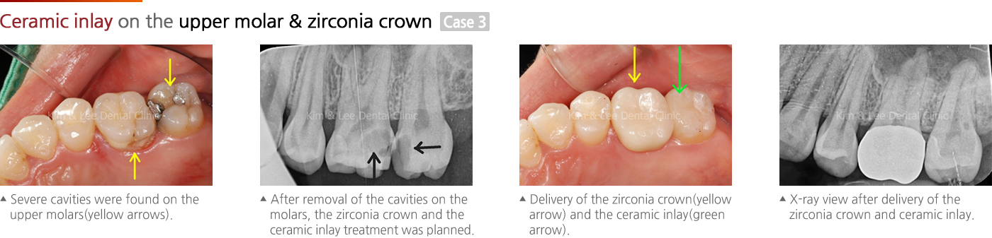 Ceramic inlay on the upper molar & zirconia crown