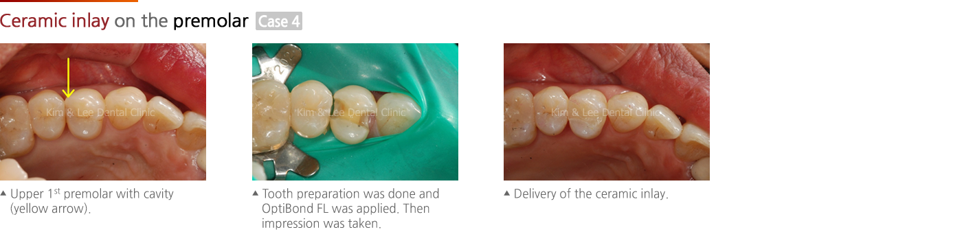 Ceramic inlay on the premolar