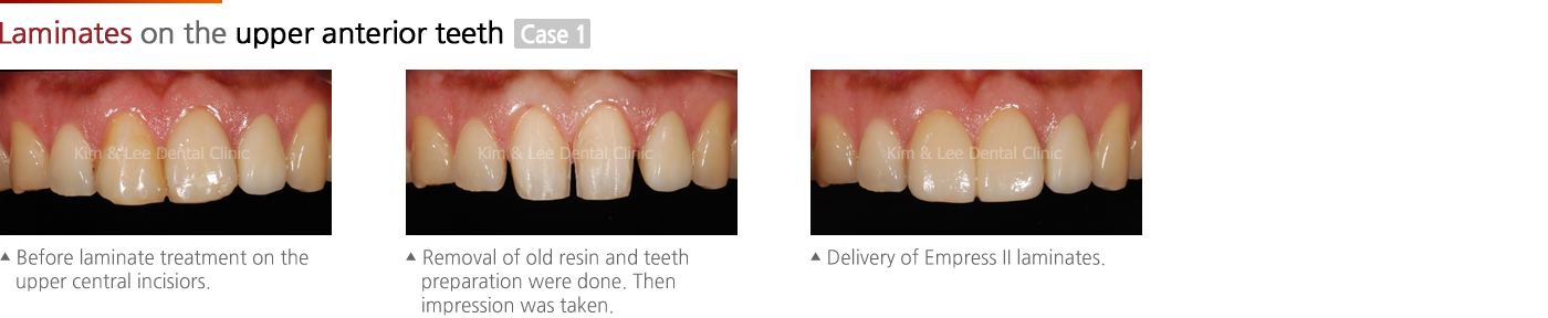 Laminates on the upper anterior teeth