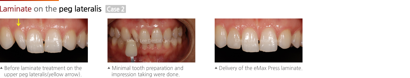 Laminate on the peg lateralis 