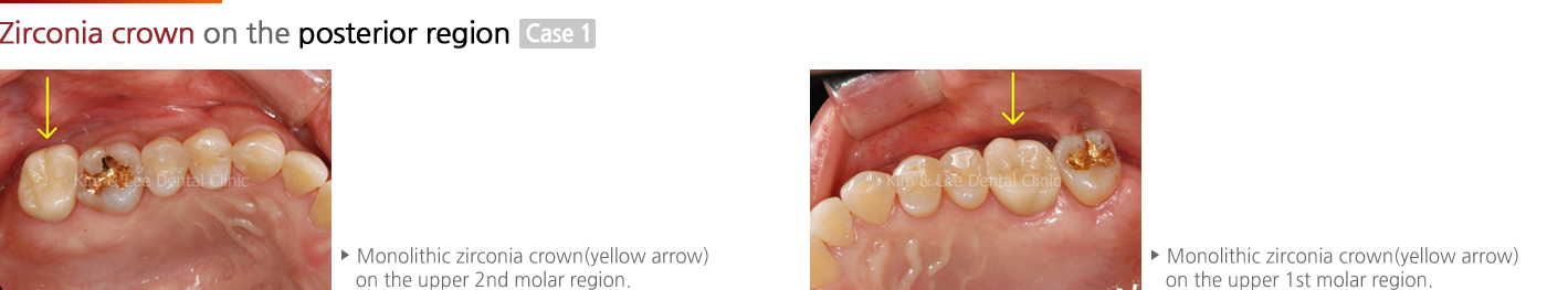 Zirconia crown on the posterior region 