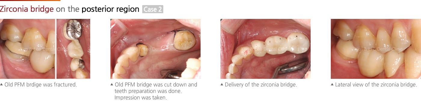 Zirconia bridge on the posterior region