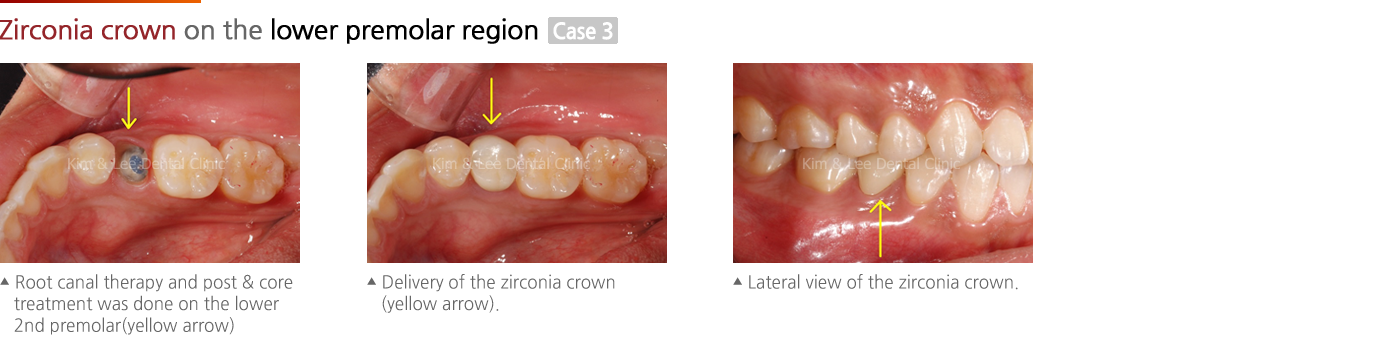 Zirconia crown on the lower premolar region