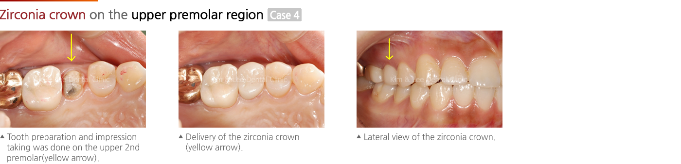 Zirconia crown on the upper premolar region