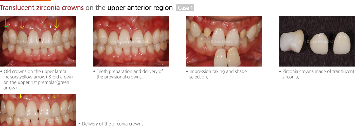 Translucent zirconia crowns on the upper anterior region