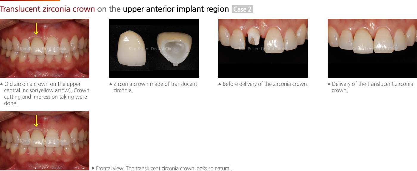 Translucent zirconia crown on the upper anterior implant region