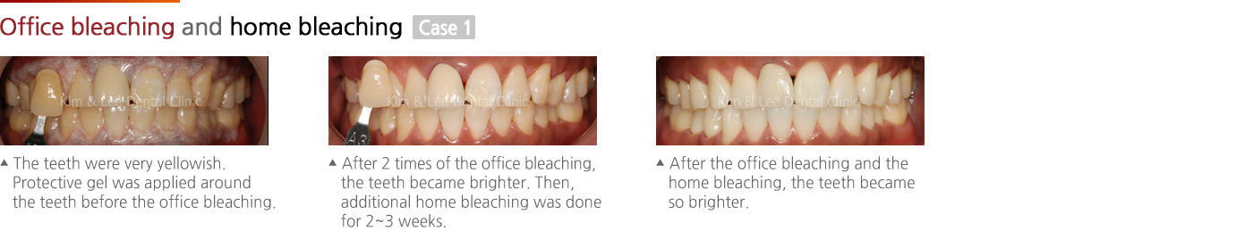 Office bleaching and home bleaching