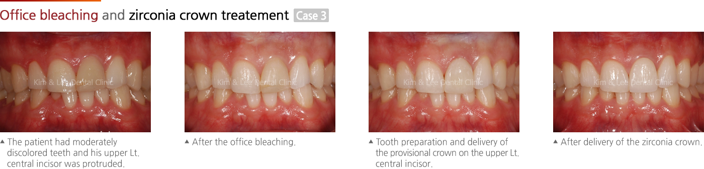 Office bleaching and zirconia crown treatement