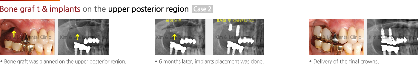 EV implant (Astra)n