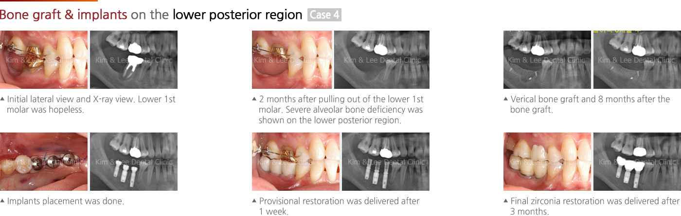 Short implant (Dentium)