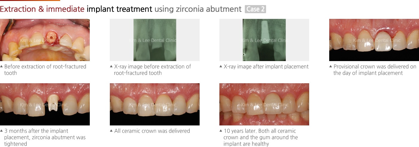 Extraction & immediate implant treatment using zirconia abutment