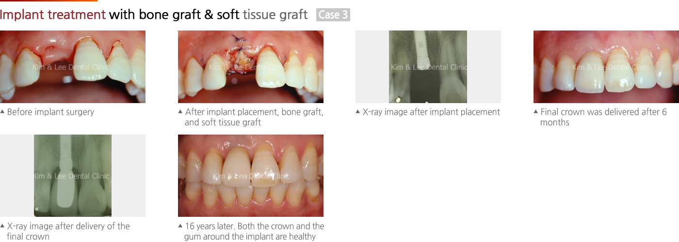 Implant treatment with bone graft & soft tissue graft