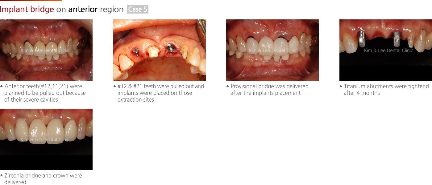 Implant bridge on anterior region