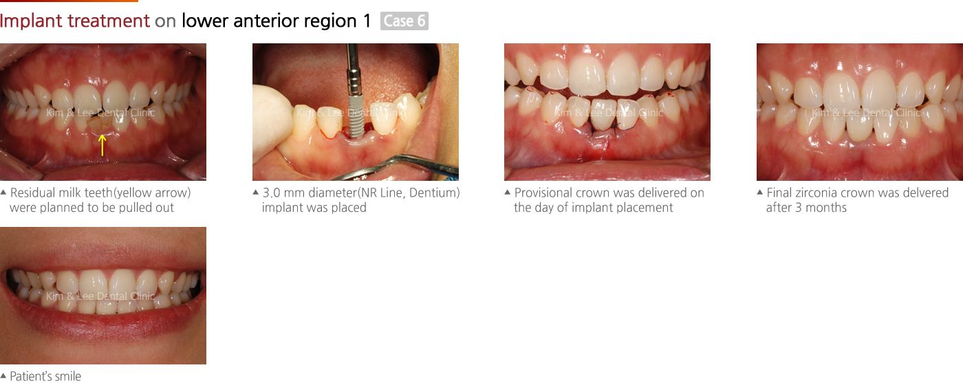 Implant treatment on lower anterior region 1