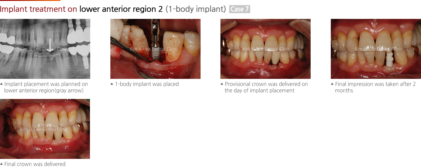 Implant treatment on lower anterior region 2 (1-body implant)