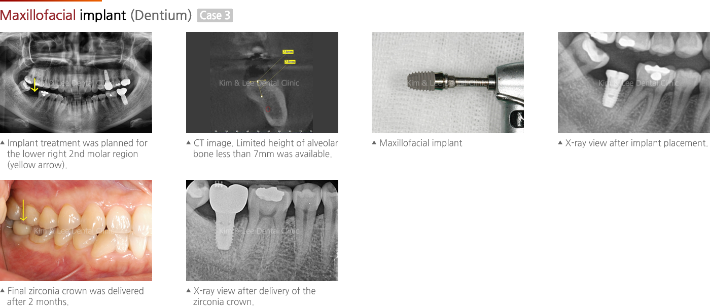 Maxillofacial implant (Dentium)