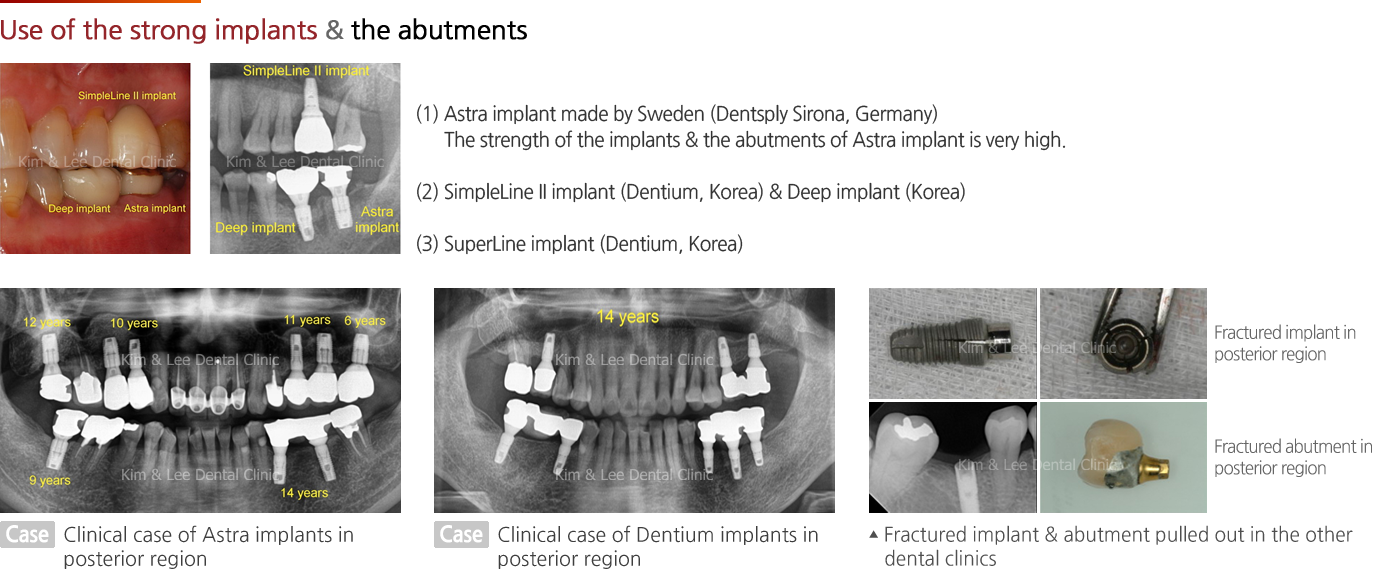 Use of the strong implants & the abutments 