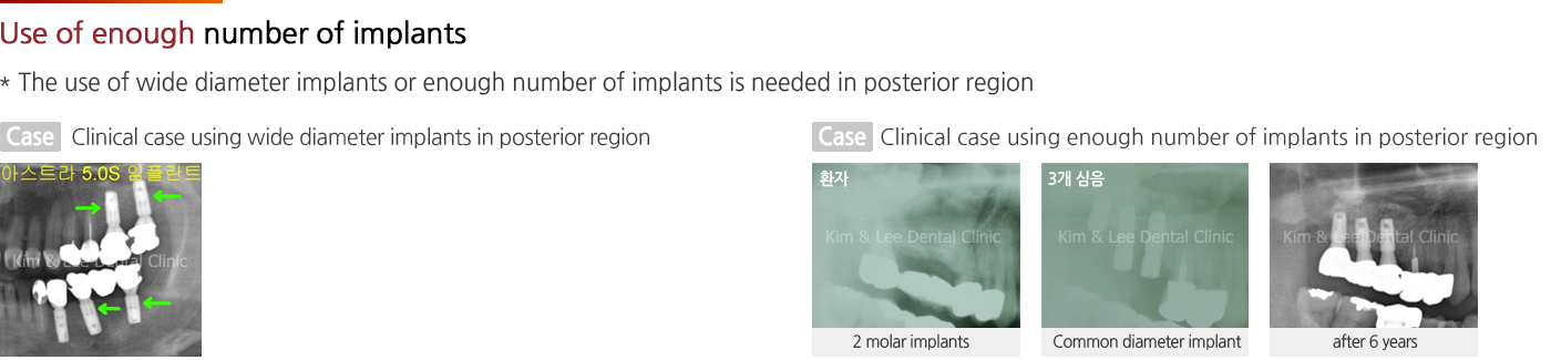 Use of enough number of implants