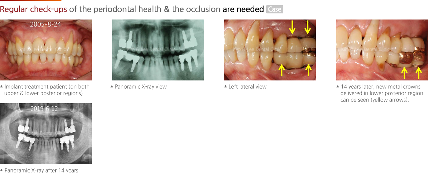 Regular check-ups of the periodontal health & the occlusion are needed 