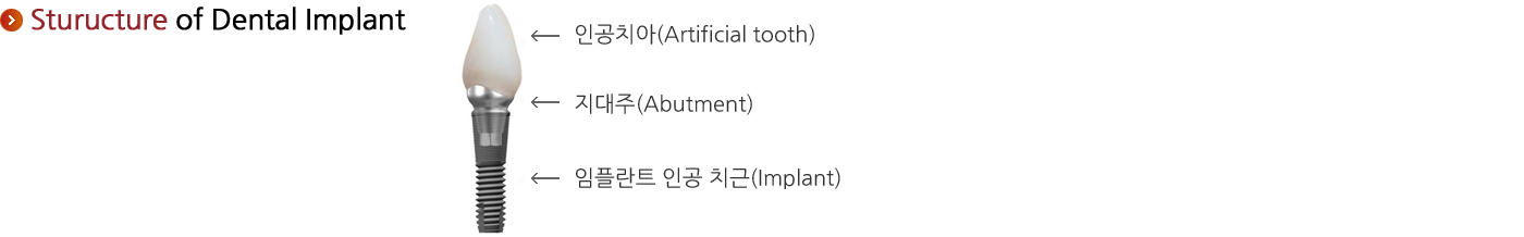 Sturucture of Dental Implant