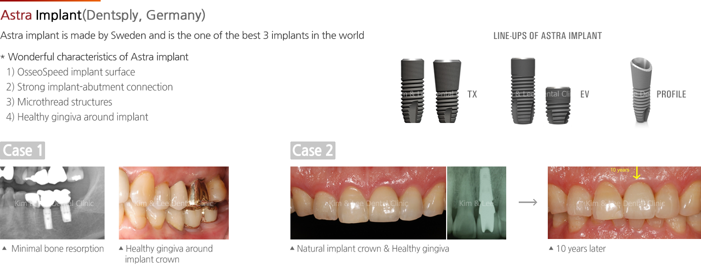 Astra Implant(Dentsply, Germany)