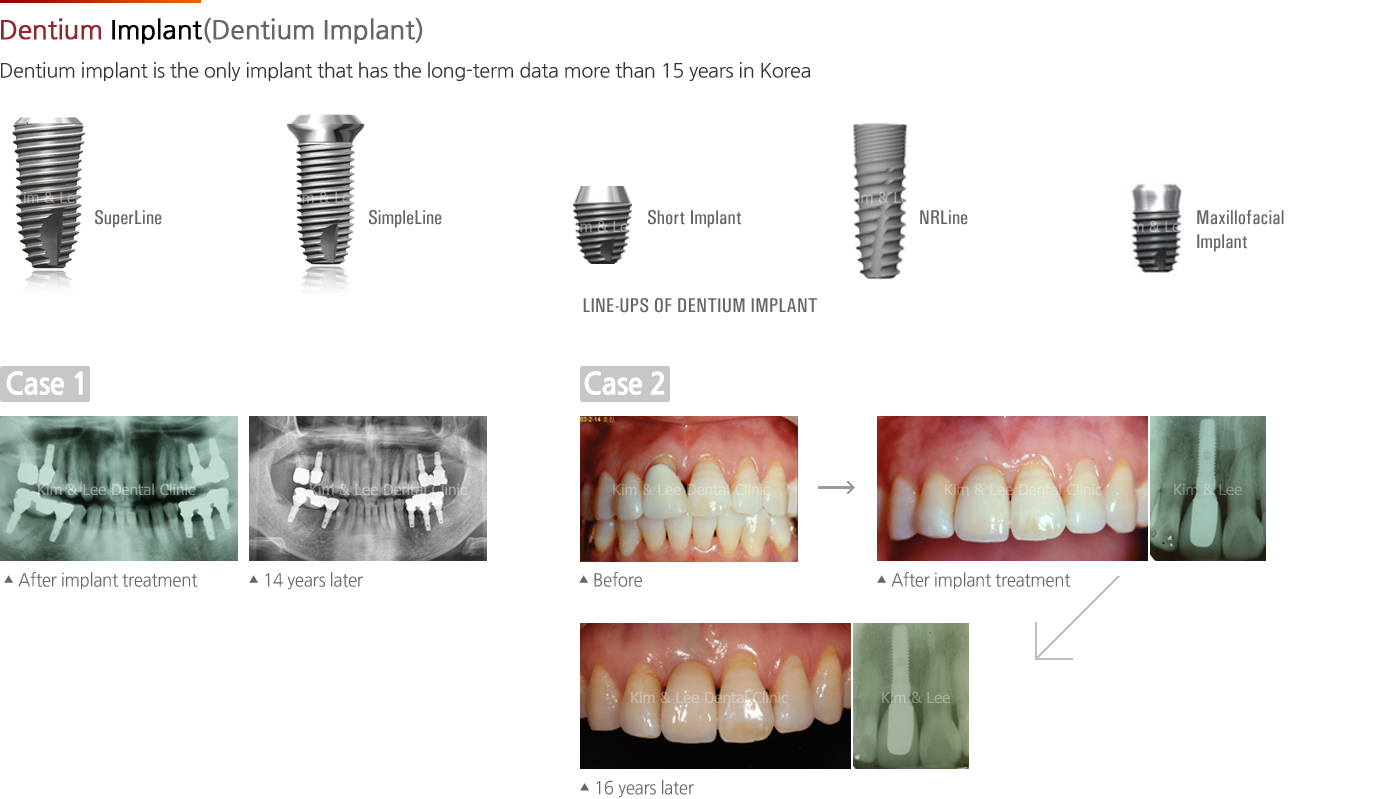 Dentium Implant(Dentium, Korea)