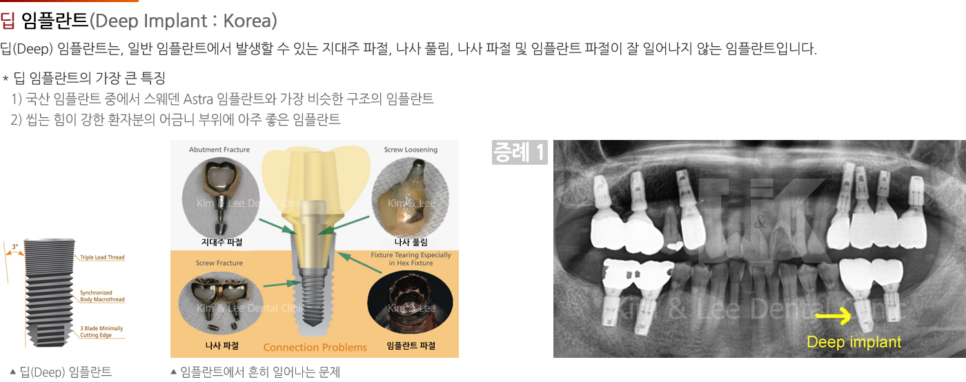 딥 임플란트 (Deep Implant : Korea