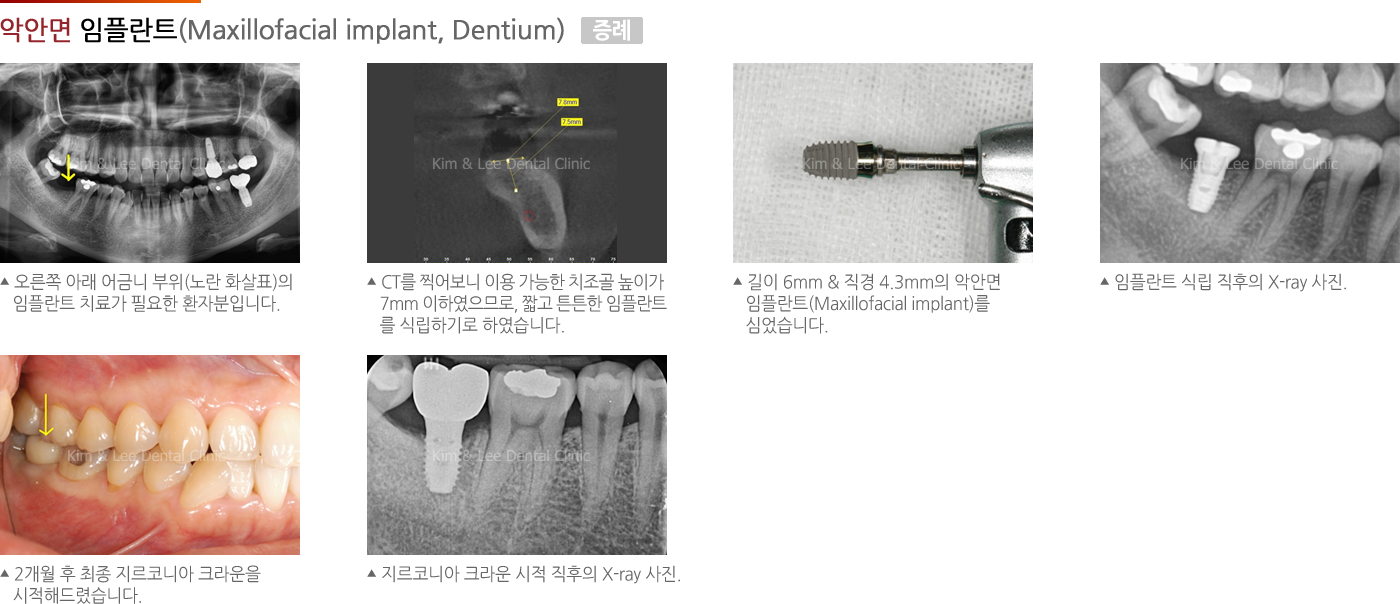 악안면 임플란트(Maxillofacial implant, Dentium)